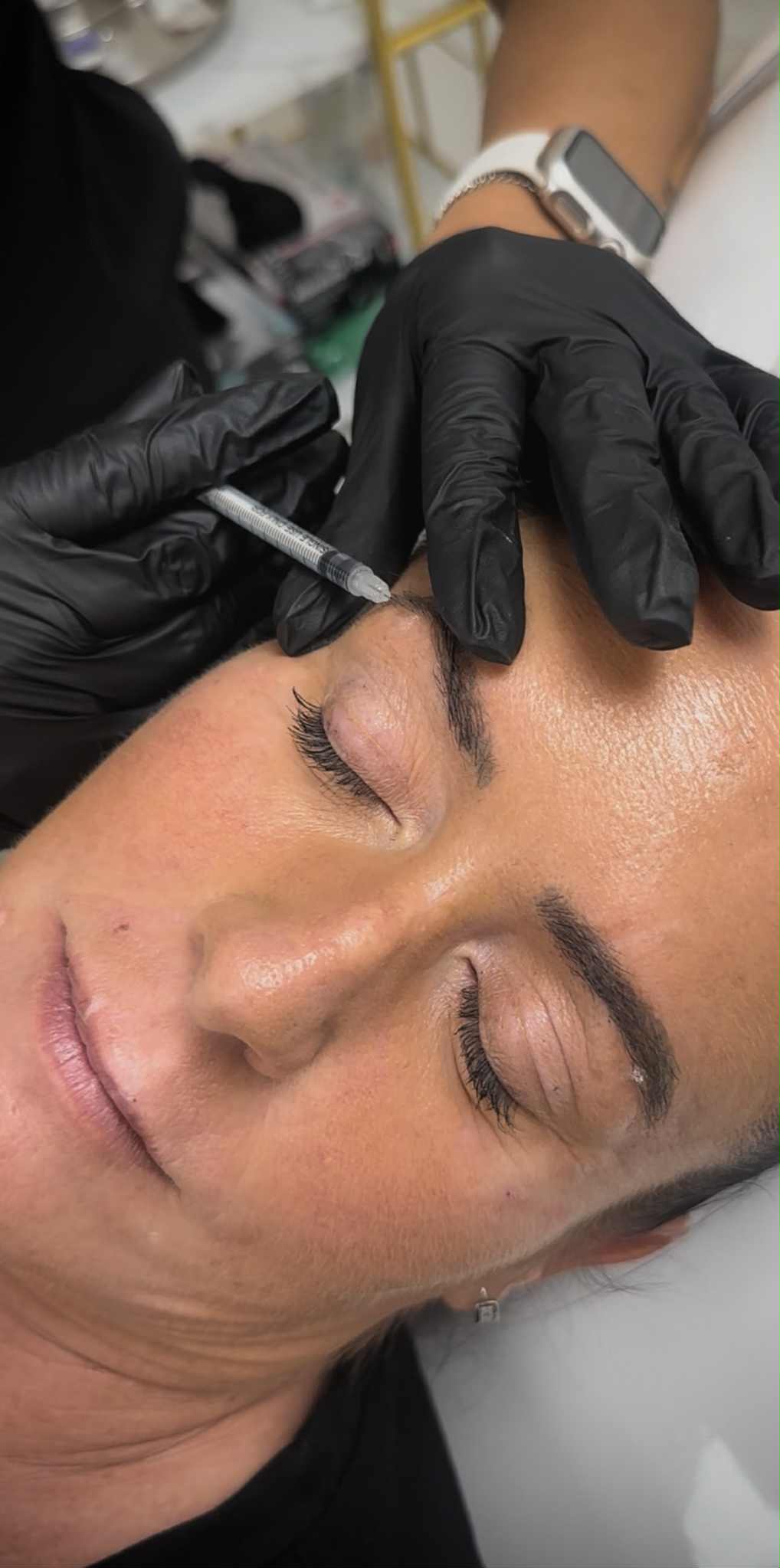 Anti-Wrinkle Treatment — Cloud Fine Aesthetics
