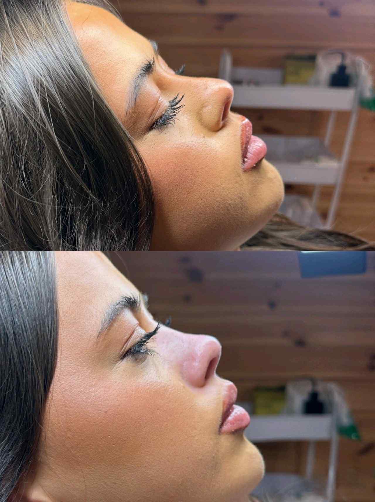 Liquid rhinoplasty — Cloud Fine Aesthetics