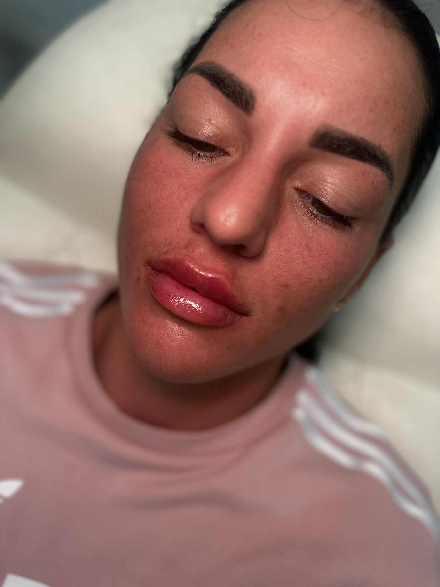 Russian lip filler — Cloud Fine Aesthetics